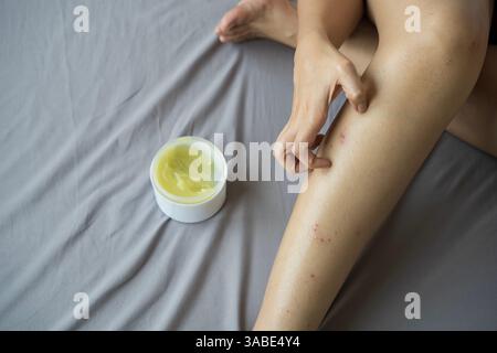 La femme applique de la crème, de la pommade sur la peau gonflante contre les piqûres de moustiques, isolé sur fond gris, gros plan. Cicatrice, et syndrome de peau rouge allerg Banque D'Images