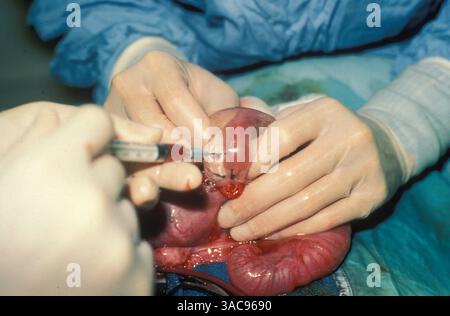 05 août 1999 - Los Angeles, Californie, États-Unis - les médecins font une greffe in utero. (Crédit image : © ZUMA Archive/ZUMA Press) RESTRICTIONS : FICHIER : date exacte et lieu inconnu Banque D'Images