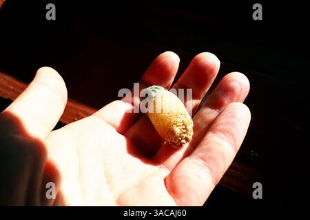 Maladie des calculs biliaires, cholélithiase - la formation de calculs, de calculs dans la vésicule biliaire, de voies biliaires. Calculs biliaires. Une grande pierre galloculaire retirée d'une patiente Banque D'Images