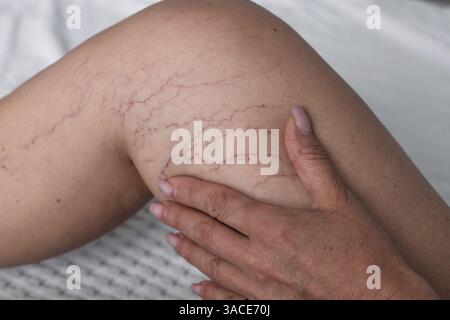 Femme assise sur le lit et montre ses jambes minces avec varicosité, maille veineuse, rosacée. Gros plan de la hanche féminine. Concept d'épilation laser et variqueuse Banque D'Images