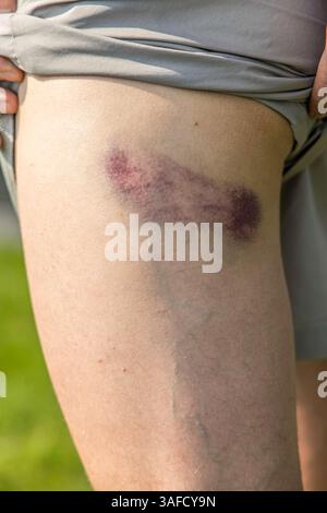 gros bleus sur la peau de jambe de l'homme en gros plan Banque D'Images