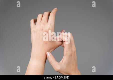 Les femmes grattent la démangeaison avec la main, le bras, les démangeaisons. Concept avec santé et médecine. Gros plan éruption allergique dermatite eczéma peau du poignet du patient. Banque D'Images