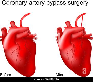 Pontage coronarien. Gros plan d'un coeur humain avant et après la greffe de contournement. Chirurgie cardiaque. Artères bloquées. Coronaropathie. Myocardi Illustration de Vecteur