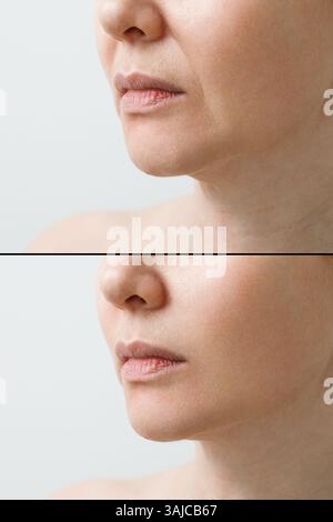 Pli nasolabial féminin avant et après les procédures de lissage des rides. Correction de la forme du menton et du cou. Banque D'Images