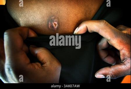 09 sept., 2009 (jwbullet) photo par Jim Weber : CLEMENTINE CRIME - Qunettia Robinson porte toujours la balle dans son dos cicatrisée après qu'elle a été tirée à travers le mur de son appartement, dommages collatéraux de fusillades à l'extérieur. Robinson a été frappée à l'épaule alors qu'elle et son petit ami se déplaçaient pour protéger ses enfants. (Crédit image : © The commercial Appeal/ZUMApress.com) Banque D'Images