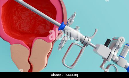 Rendu 3d du résectoscope et de l'hyperplasie bénigne de la prostate ou HBP, la glande prostatique s'agrandit. Banque D'Images