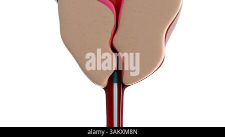 Rendu 3d du résectoscope et de l'hyperplasie bénigne de la prostate ou HBP, la glande prostatique s'agrandit. Banque D'Images