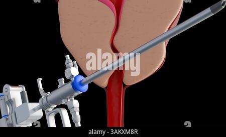 Rendu 3d du résectoscope et de l'hyperplasie bénigne de la prostate ou HBP, la glande prostatique s'agrandit. Banque D'Images