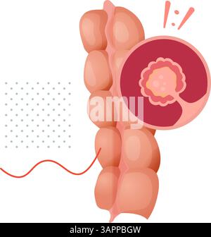 Polypes du côlon - un tissu anormal croissances - illustrations en tant que fichier EPS 10 Illustration de Vecteur