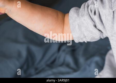 petite main d'enfant couverte d'eczéma. allergie dermatite cutanée de bébé alimentaire. Problème de symptôme de dermatite méconnaissable éruption cutanée. concept santé enfant et voiture Banque D'Images