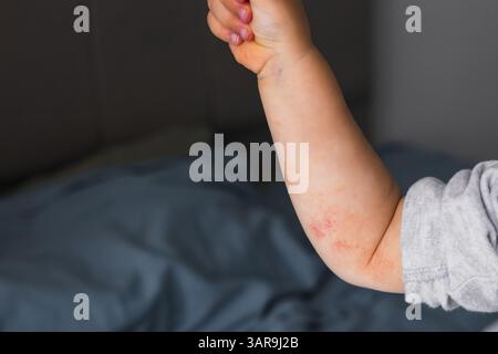 petite main d'enfant couverte d'eczéma. allergie dermatite cutanée de bébé alimentaire. Problème de symptôme de dermatite méconnaissable éruption cutanée. concept santé enfant et voiture Banque D'Images