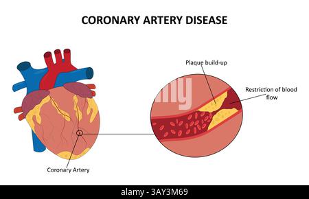 Illustration vectorielle de maladie coronarienne Illustration de Vecteur