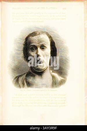 Un homme exprimant une terreur extrême, avec un visage contorsionné qui capte de manière éclatante l'intensité de ses émotions. Les détails complexes soulignent la tension dans ses traits, mettant en évidence la manifestation physique de la peur et de la détresse., terreur, d'après une photographie de Dr Duchenne, expression de la peur, Fig. 20, p. 299, 1915, Charles Darwin : L'expression des émotions chez l'homme et les animaux. New York : Appleton, 1915, Art classique avec une touche de modernité réinventé par Artotop Banque D'Images