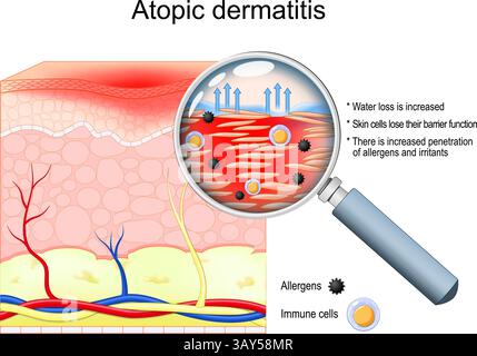 Dermatite atopique. Gros plan de la coupe transversale de la peau humaine. L'eczéma est visible à travers la loupe. La perte d'eau est augmentée. Les cellules de la peau perdent t Illustration de Vecteur
