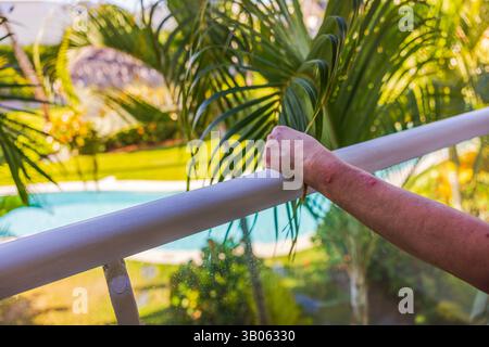Gros plan du bras de la femme avec des piqûres de moustiques visibles tout en tenant la balustrade du balcon dans le cadre du jardin tropical. Punta Cana. République dominicaine. Banque D'Images