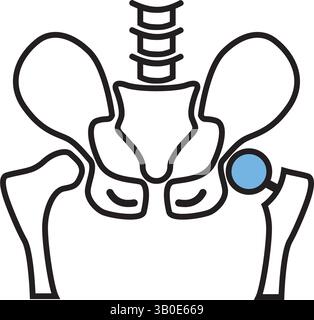 Icône noire de ligne d'arthroplastie. Implant de prothèse de hanche installé dans l'os pelvien. Elément vectoriel isolé. Illustration de Vecteur