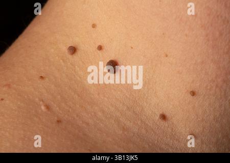 Gros plan des naevus mélanocytaires, communément appelés grains de beauté, illustrant les variations de taille, de forme et de couleur sur la peau humaine Banque D'Images