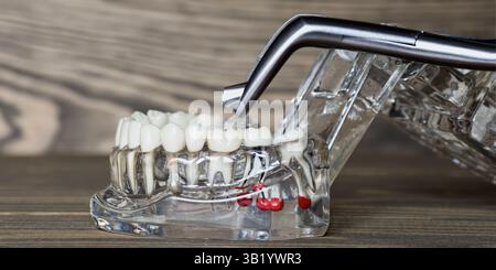 Modele de canal dentaire avec inspection METALLIQUE Banque D'Images