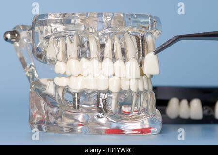 Modèle dentaire anatomique transparent montrant des implants dentaires et un être de placage Banque D'Images