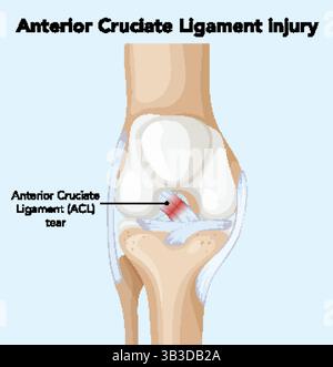 Illustration vectorielle montrant une déchirure ACL dans l'articulation du genou. Étiquetage clair et précision anatomique dans un contexte médical Illustration de Vecteur