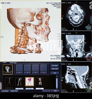 Imagerie par résonance magnétique (IRM) - tomodensitométrie de la tête humaine sur un écran d'ordinateur à ultrasons Banque D'Images