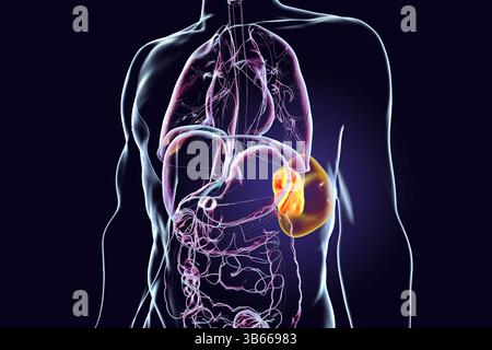 Illustration d'une splénomégalie (orange transparent), montrant une rate élargie par rapport à une rate normale (orange Uni). Cela se produit dans les infections, cirrhose du foie, leucémie, lymphome, paludisme, et les maladies auto-immunes. Banque D'Images