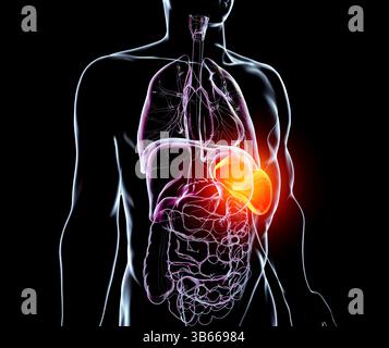Illustration d'une splénomégalie, montrant une rate élargie. Cela se produit dans les infections, cirrhose du foie, leucémie, lymphome, paludisme, et les maladies auto-immunes. Banque D'Images