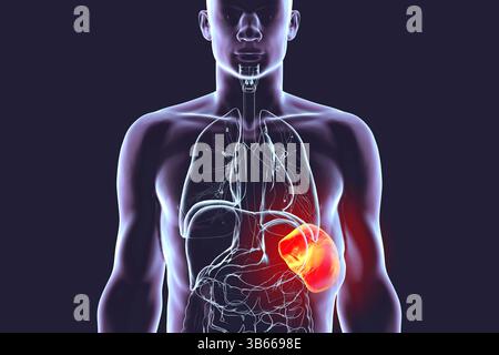 Illustration d'une splénomégalie, montrant une rate élargie. Cela se produit dans les infections, cirrhose du foie, leucémie, lymphome, paludisme, et les maladies auto-immunes. Banque D'Images