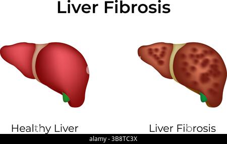 Illustration vectorielle de conception de cirrhose du foie Illustration de Vecteur