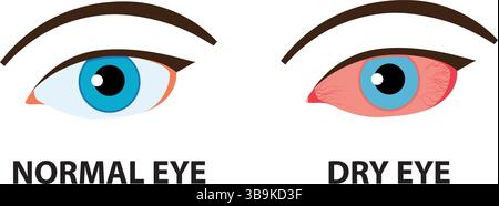 Illustration de comparaison entre l'œil normal et l'œil sec. Illustration de Vecteur