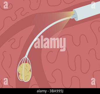 Retrait d'une pierre du canal de glande salivaire. Illustration vectorielle de sialendoscopie Banque D'Images