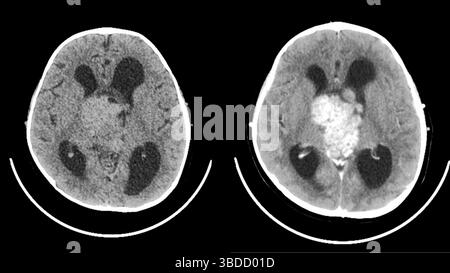 Tomodensitométrie (TDM) du cerveau d'un patient présentant un épendymome (blanc). Les épendymomes sont des tumeurs malignes rares (cancéreuses) du système nerveux central (cerveau et moelle épinière). Ils proviennent des cellules tapissant les cavités (ventricules) du cerveau. Banque D'Images