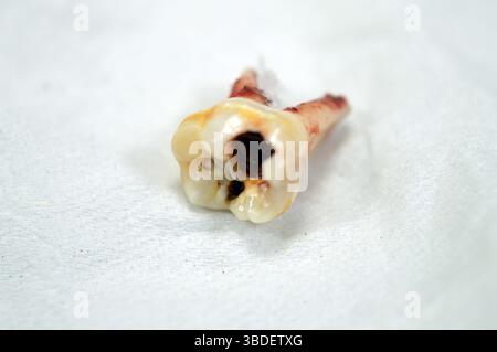 Un extrait à feuilles caduques primaires de bébé dents temporaires, le premier ensemble de dents dans la croissance et le développement des humains, que l'inflammation et dentaire Banque D'Images