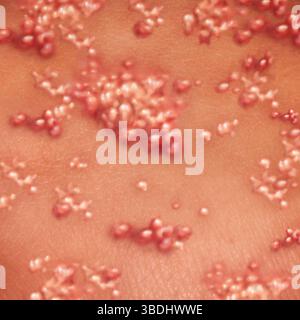 Virus de l'herpès et zona comme une éruption cutanée contagieuse avec des cloques comme les boutons de fièvre ou la maladie d'éclosion de varicelle comme un concept d'illustration médicale. Banque D'Images