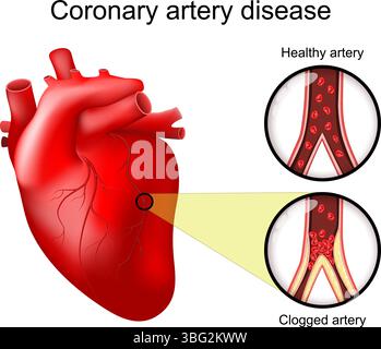 Coronaropathie. Cœur humain réaliste. Gros plan d'une artère saine et d'une coupe transversale d'une artère obstruée. Athérosclérose. Ischémie myocardique. Illustration de Vecteur