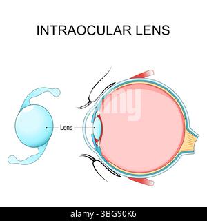 Anatomie oculaire. Coupe transversale de l'œil humain. Gros plan de la lentille intraoculaire. Position et emplacement de l'implant IOL. Illustration schématique. schéma médical. DET Illustration de Vecteur