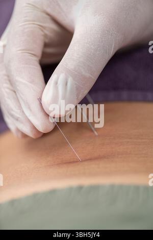 Physiothérapeute effectuant un aiguilletage sec sur le bas du dos d'un patient pour soulager les douleurs musculaires, favorisant la guérison grâce à une thérapie ciblée de point de déclenchement. Banque D'Images