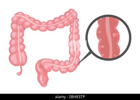 Polypes se développant dans le gros intestin, entraînant divers problèmes intestinaux, représentés dans une illustration anatomique avec une vue agrandie Illustration de Vecteur