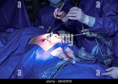 LK Osnabrück, Deutschland 30. Januar 2023 : Im Bild : Minimalinvasiver Eingriff BEI einer Gallenblasenoperation in einem hochmodernen Operationssaal eines Krankenhauses. Der Operateur, in steriler OP-Kleidung und mit chirurgischen Handschuhen, arbeitet konzentriert durch kleine, präzise Hautschnitte in der Bauchdecke des Patienten. Durch diese minimalen Zugänge werden eine Kameraoptik und spezielle chirurgische Instrumente eingeführt. Die Kamera liefert Live-Bilder des Operationsfeldes auf Monitore, während der Chirurg mit den feinen Instrumenten den Eingriff präzise durchführt. Die Szene Verdeu Banque D'Images