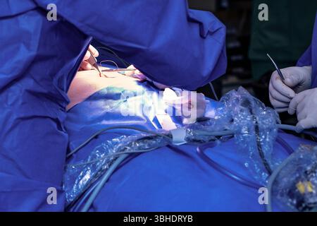 LK Osnabrück, Deutschland 30. Januar 2023 : Im Bild : moment des Wundverschlusses in einem hochmodernen Operationssaal eines Krankenhauses. Der Operateur, gekleidet in stérile OP-Kleidung und mit chirurgischen Handschuhen, widmet sich der Feinarbeit, indem er die kleinen, präzisen Hautschnitte an der Bauchdecke des Patienten vernäht. Diese Schnitte wurden zuvor für einen minimalinvasiven Eingriff, wie eine Laparoskopie oder Endoskopie, gesetzt. Mit äußerster Sorgfalt und Präzision führt der Chirurg die Nadel und den Faden, um eine optimale Wundheilung und minimale Narbenbildung zu gewährleisten. Banque D'Images