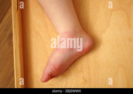Peau rouge et gonflée sur le pied d'un enfant causée par une piqûre de moustique après un jeu en plein air en été Banque D'Images