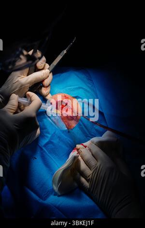 Chirurgie dermatologique au bloc opératoire. Injection d'anesthésie dans la lésion.carcinome épidermoïde.les mains d'un chirurgien et de son assistant int Banque D'Images