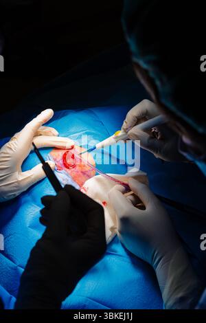 Chirurgie dermatologique au bloc opératoire. Coagulation de la lésion et aspiration de liquide. Carcinome épidermoïde. Les mains d'un chirurgien et de son assistance Banque D'Images