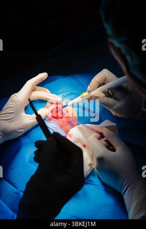 Chirurgie dermatologique au bloc opératoire. Coagulation de la lésion et aspiration de liquide. Carcinome épidermoïde. Les mains d'un chirurgien et de son assistance Banque D'Images