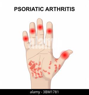 Illustration du rhumatisme psoriasique Banque D'Images