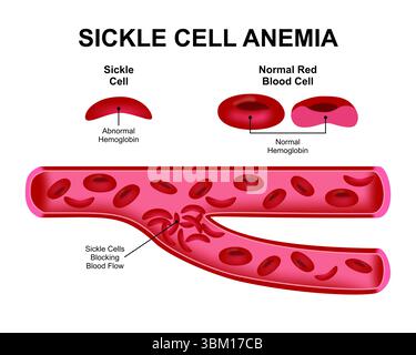 Illustration de la drépanocytose Banque D'Images