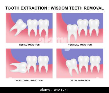 Extraction dentaire - enlèvement des dents de sagesse Banque D'Images