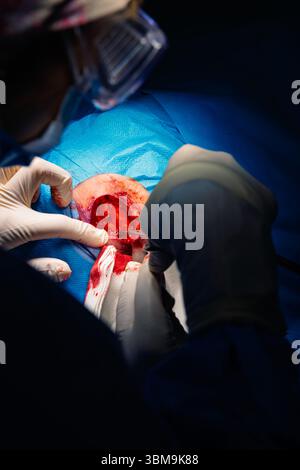 Chirurgie dermatologique au bloc opératoire. Coagulation des vaisseaux sanguins de la plaie chirurgicale. Carcinome épidermoïde. Les mains d'un chirurgien et salut Banque D'Images