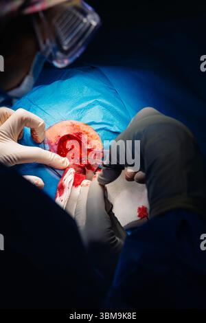 Chirurgie dermatologique au bloc opératoire. Coagulation des vaisseaux sanguins de la plaie chirurgicale. Carcinome épidermoïde. Les mains d'un chirurgien et salut Banque D'Images