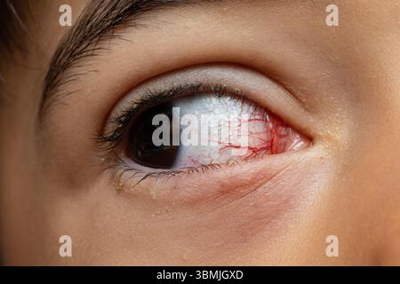 Gros plan des yeux rouges montrant capillaires et irritation, allergie oculaire, conjonctivite Banque D'Images